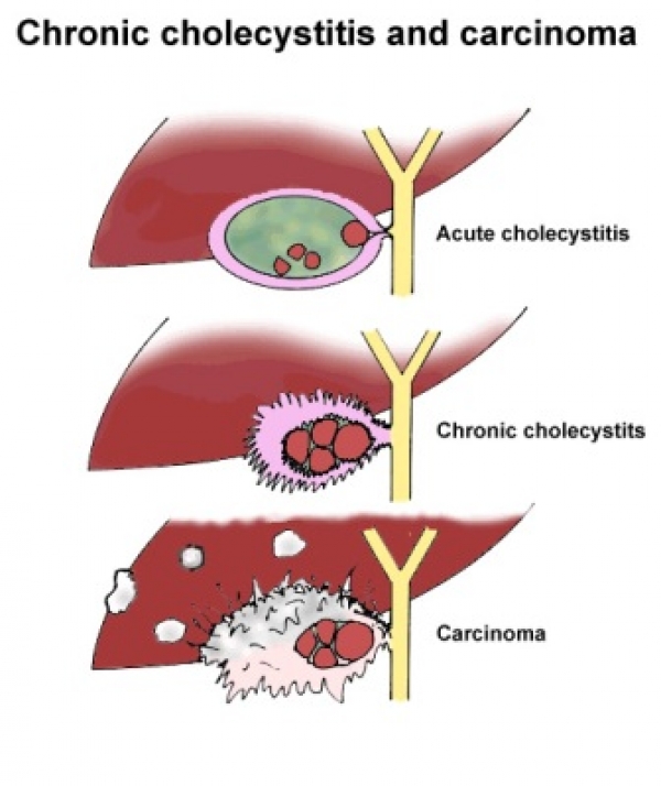 Что такое холецистит желчного. Острый холецистит желчного пузыря. Холецистит атонический. Хронический холецистит. Конический холецистит.