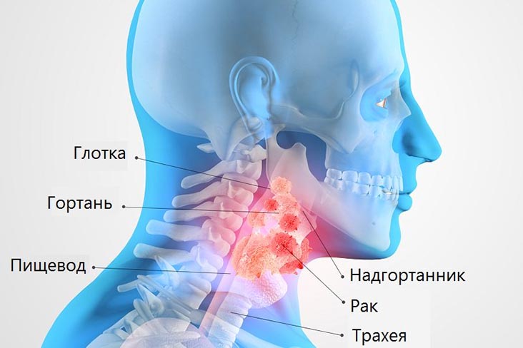 рак горла лечение в клинике Доктор Кредо
